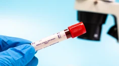 Ako sa prenáša ebola? Infektológ vysvetlil príznaky aj úmrtnosť