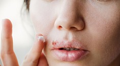 Bolestivé opary: Zistite, prečo vznikajú a ako ich môžete účinne vyliečiť