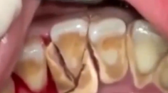 Muž si neumyl zuby 10 rokov! Takto vyzeralo čistenie