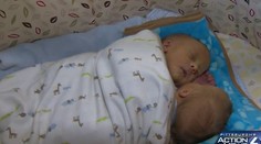 Siamské dvojičky zomreli po necelých troch mesiacoch