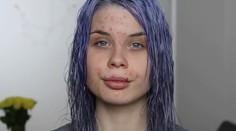 Slovenka chcela pomôcť dievčatám s akné. Takéto kruté reakcie nečakala