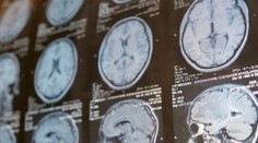 Vedci tvrdia, že vedia, prečo ľudia so schizofréniou „počujú hlasy“