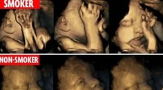 Ultrazvukové snímky ukazujú, aký vplyv má fajčenie na bábätko