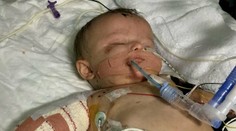 Takto by deti nemali trpieť: Bábätku museli amputovať všetky končatiny