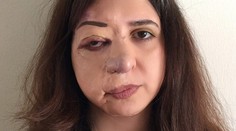 Roky si o nej mysleli, že má nákazlivú chorobu. Ľudia nechceli, aby vychádzala z domu