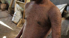 Choroba tínedžera desí ľudí. Koža sa mu olupuje ako hadovi