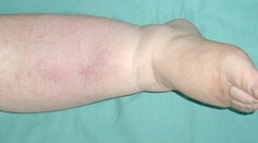 "Bacha" na opuchnuté nohy