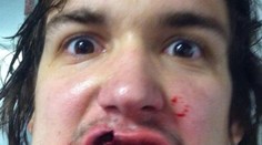 Hokejista dostal pukom do úst. Na internete sa chválil, čo mu z nich ostalo