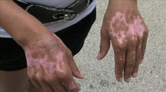 Aký trest dostal žiarlivec, ktorý pred rokom zapálil vlastnú ženu?