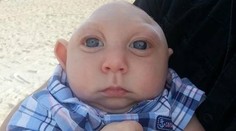 Napriek hrozivej diagnóze, chlapček bez mozgu oslávil rok života