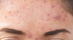 Keď sa zjaví, máte chuť si dať vrece na hlavu. Takto sa zbavíte akné