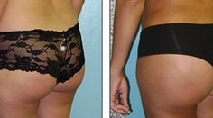 Silikóny v zadku sú hit. Fotky pred a po