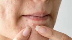 Ako sa vyhnúť vyrážkam na tom najhoršom mieste? A tvár to nie je