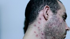 Veľká Británia potvrdila komunitné šírenie opičích kiahní