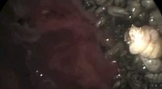 Šokujúce video: Muž mal v nose 100 mäsožravých červov