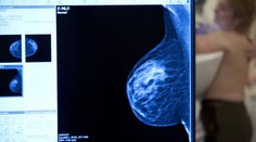 Štúdia spochybnila význam mamografického vyšetrenia prsníka