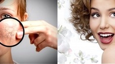 Nechajte si okamžite odstrániť vrásky- svetová novinka v estetickej medicíne