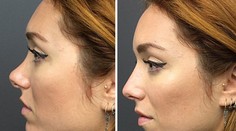 Lekár jej vylepšil nos za päť minút. Bez plastiky!