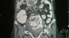 Žene (60) našli v tele 36-ročnú kostru dieťaťa