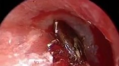 Chlapec viac dní počul v uchu čudné zvuky: Keď ho prezreli lekári, neverili, čo vidia