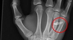 Röntgen odhalil príčinu opuchu. Mladík mal v ruke zub