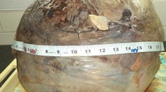 Žena ani netušila, že má v sebe viac ako 13-kilový nádor veľký ako melón