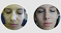 Tínedžeri pozor: S týmto prístrojom sa akné zbavíte už nadobro!