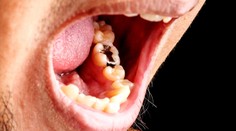 Pýtali sme sa za vás: Čo u zubára preplácajú poisťovne?