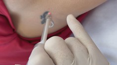 Namiesto tetovaní je trendom čistá pokožka. Boli sme sa pozrieť, ako vyzerá odstránenie laserom