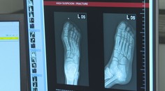 Košickí lekári na urgente využívajú umelú inteligenciu. Dokáže zbadať aj tie najmenšie zlomeniny