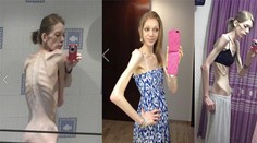 Mladá anorektička bola na hranici smrti. Dnes je z nej sexy kráska