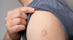 Známa jazva na ramene. Po akom očkovaní vznikla a prečo ju nemá každý
