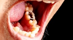 Amalgánové plomby končia, toto má byť náhrada. Zisťovali sme výhody a nevýhody