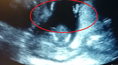 Prekvapenie na ultrazvuku: Len 14-týždňový plod začal tlieskať