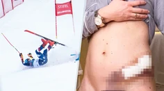 FOTO: Len pre silné žalúdky. Shiffrinová si takmer prepichla orgány. Lyžiarka ukázala rany po škaredom páde
