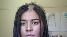 Dievča sa pýšilo krásnymi vlasmi. Zobudila sa s veľkou plešinou