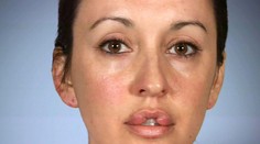 Desať rokov nezatvorila ústa. Chcela ich mať ako Angelina Jolie