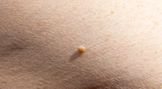 Malé kožné výrastky vyzerajú nevinne. Dermatologička varuje pred ich domácim odstraňovaním