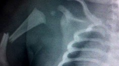 V Británii dievčatku pri pôrode naschvál zlomili ruku