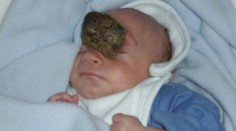 Jamie sa narodil s mozgom mimo lebky. Mal žiť len hodinu, on však oslávil 10. narodeniny