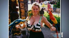 Nechutné FOTO! Takto to vyzerá, keď žene vyberú obrovské silikóny