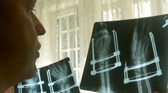 Nejeden Slovák trpí chorobou čiernych kostí. Je to poriadne svinstvo!