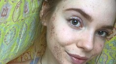 Pre škaredé akné nevychádzala z domu. Dnes jazvy hrdo vystavuje