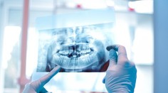 Muž prišiel pri zákroku na klinike v Turecku o všetky zuby. Príbeh sa skončil obrovskou tragédiou