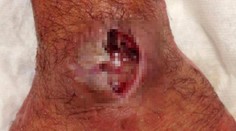 Zdvihne sa vám žalúdok. Muža ukrýzol pavúk a toto mu zostalo na ruke