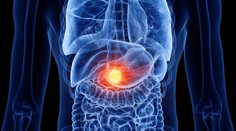 Rakovina pankreasu je jedným z najzákernejších onkologických ochorení. Týchto desať príznakov by ste nemali ignorovať