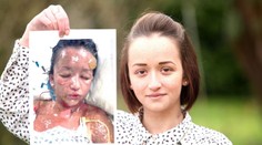 Tínedžerka utrpela strašnú alergickú reakciu na tabletky