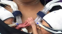 Milióny ľudí sa zamilovali do malinkých dvojičiek. Stále sa držia za ruky