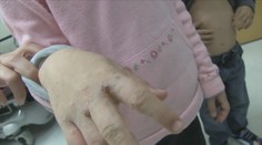 Ďalšie infekčné ochorenie v bratislavskej škôlke. Po žltačke sa objavil svrab