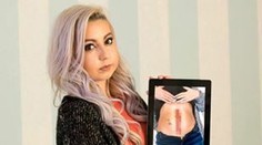 Hrôzostrašný prípad: Žene praskla jazva, videla si až do žalúdka